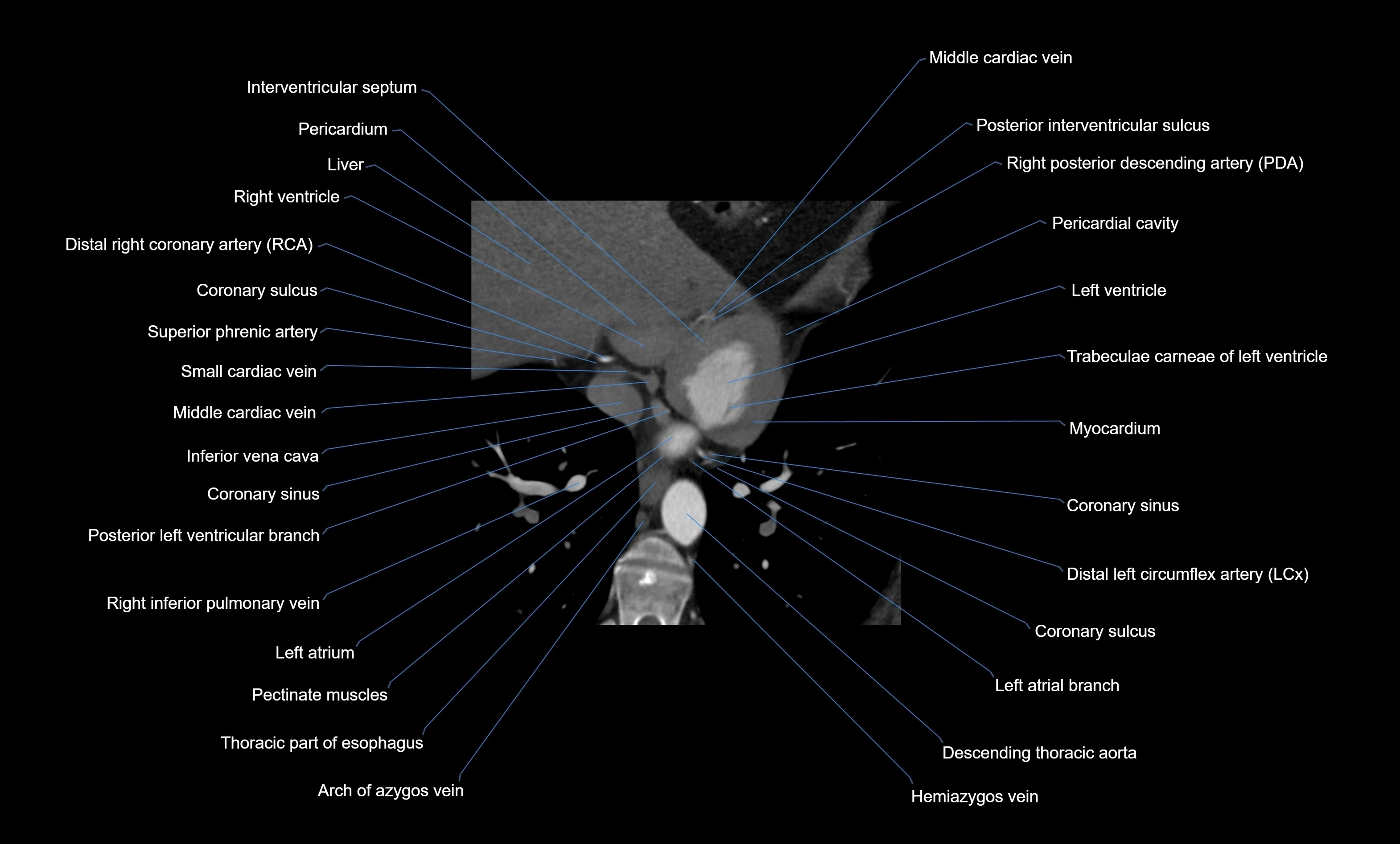 CT heart (coronary angiogram) four chamber view  cross sectional anatomy labelled radiology image -00038.webp